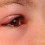 swelling kids' eye