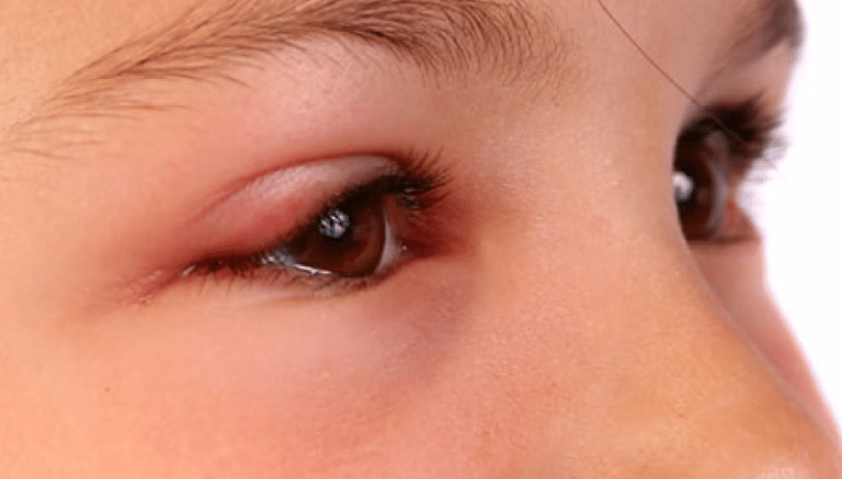 swelling kids' eye