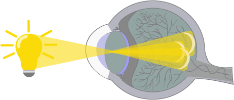 An illustration of the eyeball and how light is reflected when a child has astigmatism