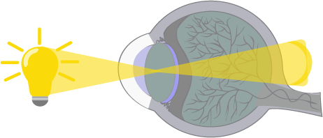An illustration of the eyeball and how light is reflected when a child has hyperopia