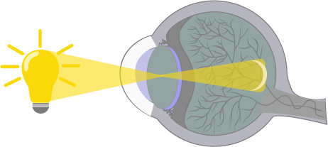 An illustration of the eyeball and how light is reflected when a child has myopia
